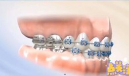 牙齿矫正视频全过程,从咨询到戴牙套的蜕变之旅