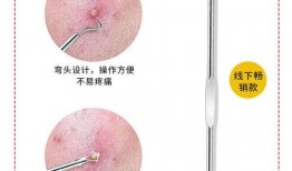暗疮针去黑头 视频,轻松告别顽固黑头