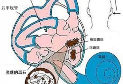 耳石症眩晕怎么办最快最有效视频,视频教程详解