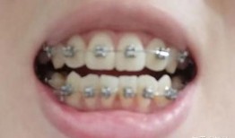 牙齿矫正视频全过程,从咨询到戴牙套的蜕变之旅