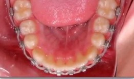 牙齿矫正视频全过程,从咨询到戴牙套的蜕变之旅